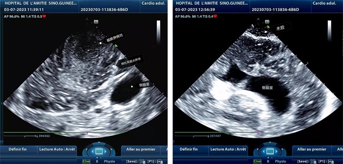 左圖顯示術(shù)中超聲見囊實(shí)性病變，大小約為4x4x3cm，病灶周圍腦組織水腫明顯；右圖為病灶切除后，術(shù)中超聲示術(shù)腔無病變殘留