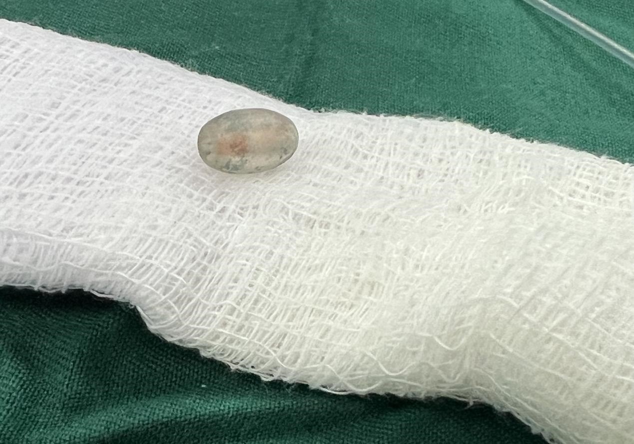 被取出的異物。中國(guó)援桑醫(yī)療隊(duì)供圖