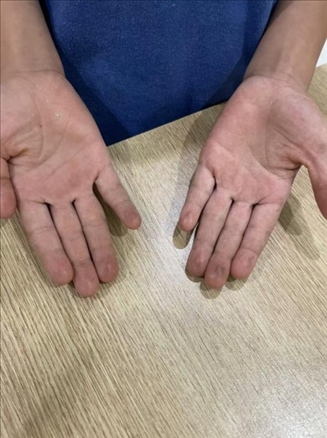 9歲小學(xué)生長期拍煙卡，手部粗糙長繭。受訪者供圖