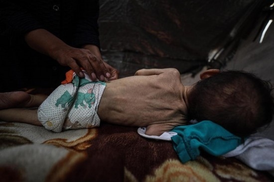 這是5月28日在加沙城西部一處臨時(shí)安置點(diǎn)拍攝的一名營養(yǎng)不良的嬰兒。新華社發(fā)（馬哈茂德·扎基攝）